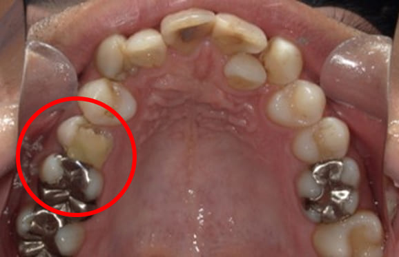 藤沢デンタルオフィスの虫歯や破折で抜歯後の部分矯正