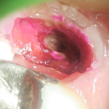 藤沢デンタルオフィスの虫歯や破折で抜歯後の部分矯正