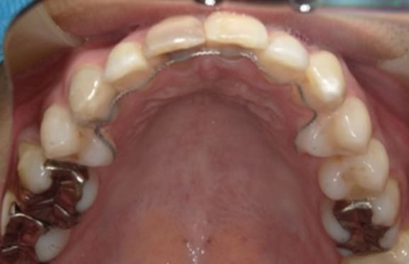 藤沢デンタルオフィスの虫歯や破折で抜歯後の部分矯正