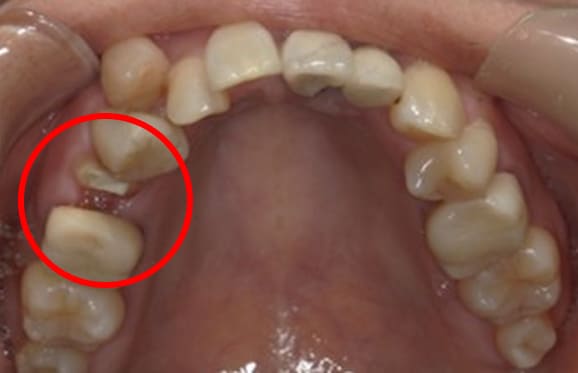 藤沢デンタルオフィスの虫歯や破折で抜歯後の部分矯正