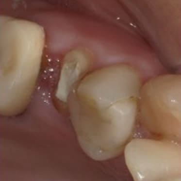 藤沢デンタルオフィスの虫歯や破折で抜歯後の部分矯正