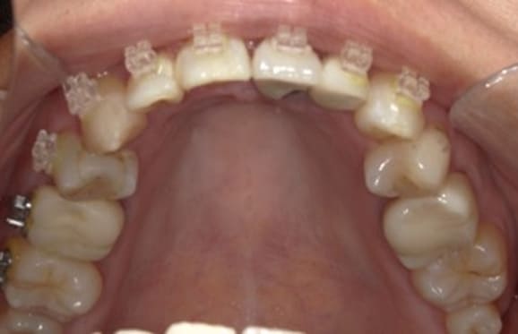 藤沢デンタルオフィスの虫歯や破折で抜歯後の部分矯正