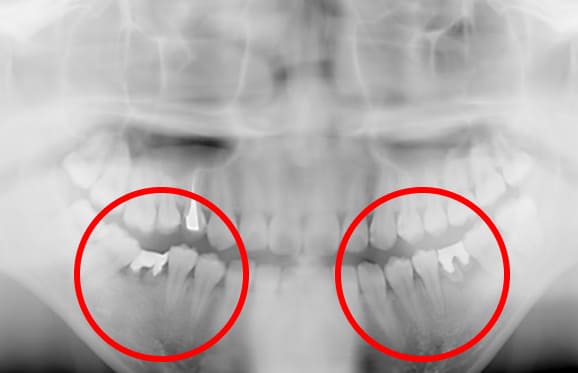 藤沢デンタルオフィスの虫歯や破折で抜歯後の部分矯正