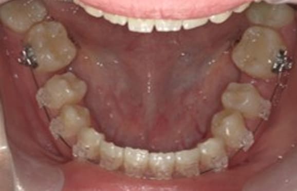 藤沢デンタルオフィスの虫歯や破折で抜歯後の部分矯正
