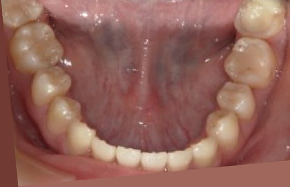 藤沢デンタルオフィスの虫歯や破折で抜歯後の部分矯正