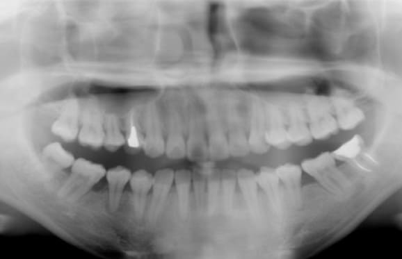 藤沢デンタルオフィスの虫歯や破折で抜歯後の部分矯正