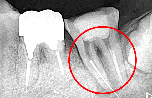 藤沢デンタルオフィスの破折ファイル除去