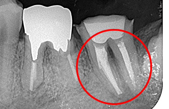 藤沢デンタルオフィスの破折ファイル除去