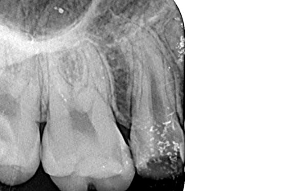 藤沢デンタルオフィスの破折ファイル除去