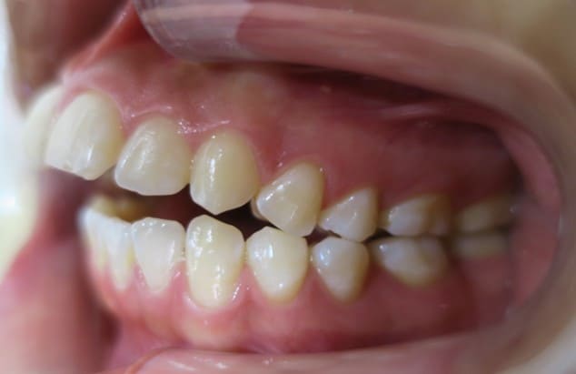 藤沢デンタルオフィスのマウスピース矯正