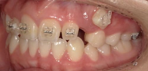 藤沢デンタルオフィスの部分矯正