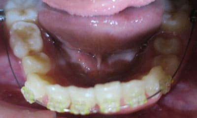 藤沢デンタルオフィスのワイヤー矯正