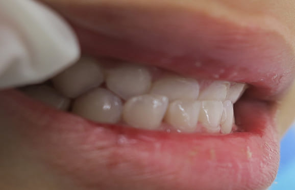 藤沢デンタルオフィスの咬み合わせ予防