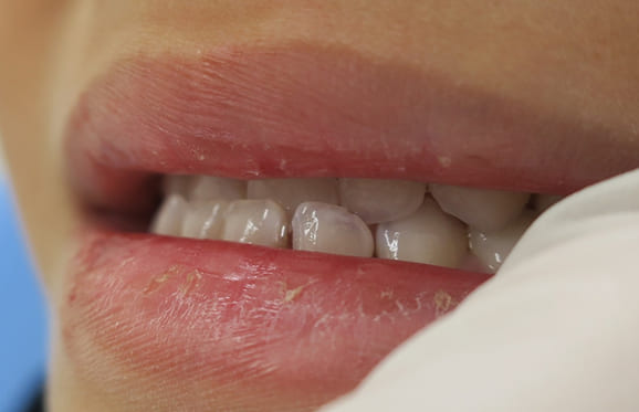 藤沢デンタルオフィスの咬み合わせ予防