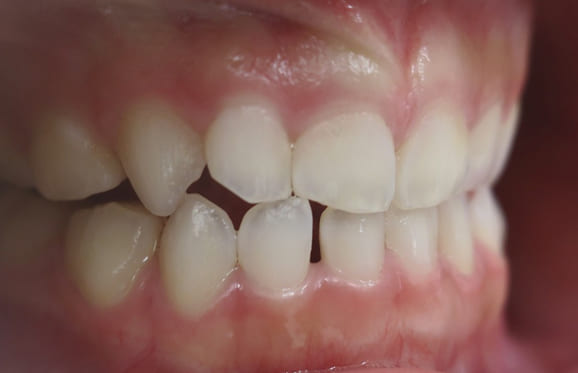 藤沢デンタルオフィスの咬み合わせ予防