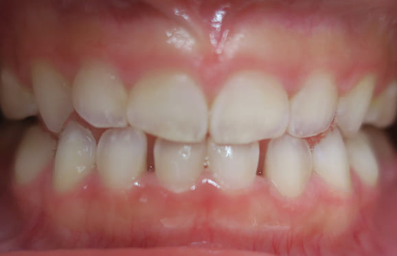 藤沢デンタルオフィスの咬み合わせ予防