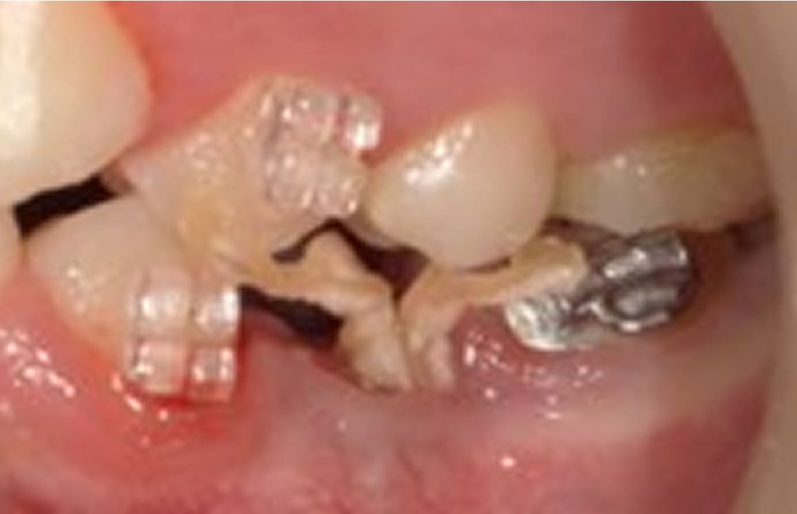 藤沢デンタルオフィスのホワイトニング術前