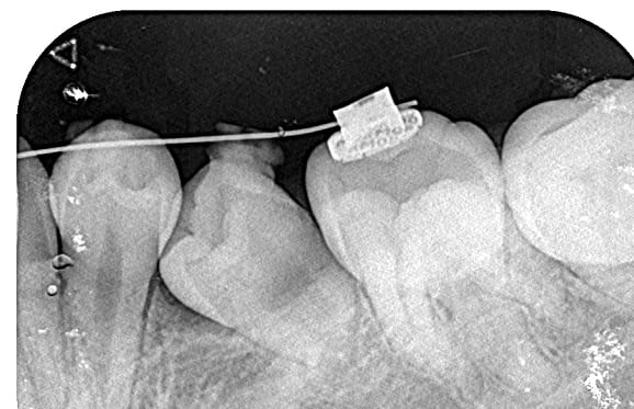 藤沢デンタルオフィスの虫歯や破折で先天性の萌出方向異常を部分矯正で治療
