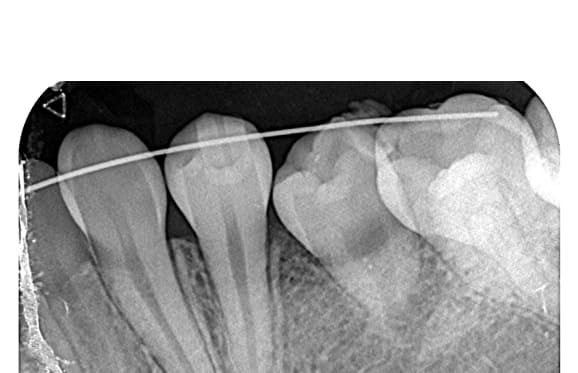 藤沢デンタルオフィスの虫歯や破折で先天性の萌出方向異常を部分矯正で治療