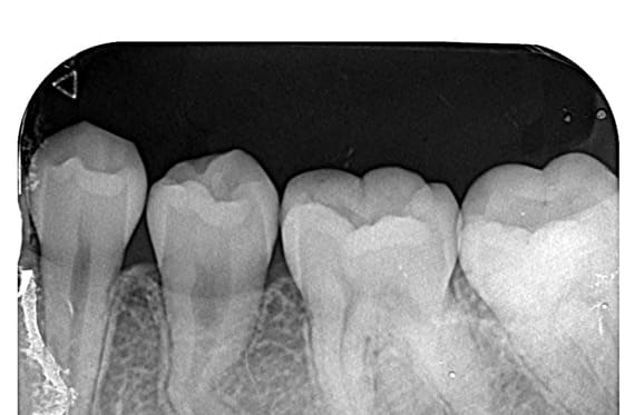 藤沢デンタルオフィスの虫歯や破折で先天性の萌出方向異常を部分矯正で治療