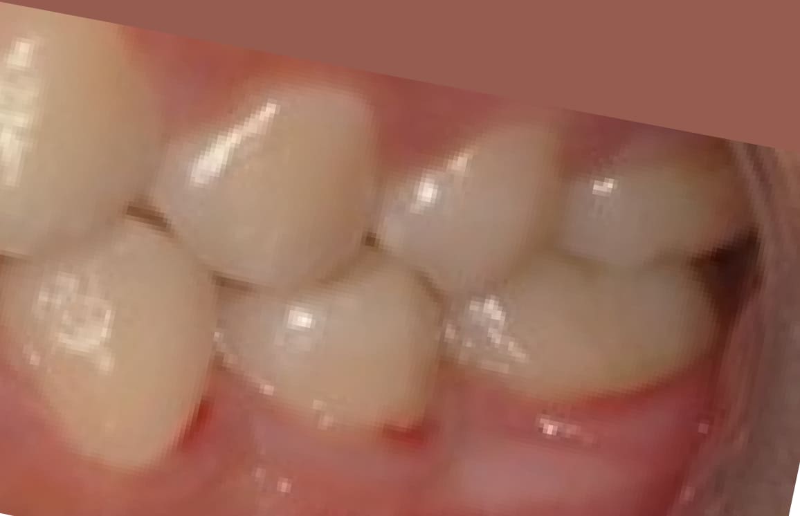 藤沢デンタルオフィスのホワイトニング術後