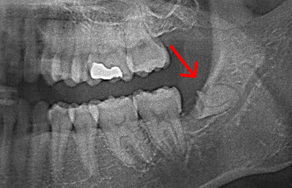 藤沢デンタルオフィスの親知らず抜歯