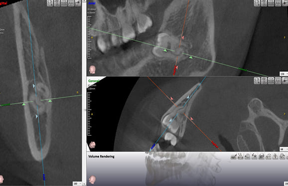 藤沢デンタルオフィスの親知らず抜歯