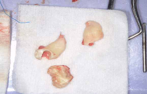 藤沢デンタルオフィスの親知らず抜歯