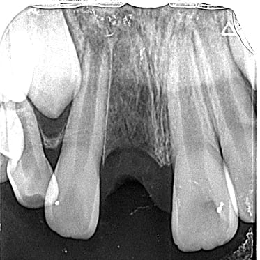 藤沢デンタルオフィスの完全脱臼術前