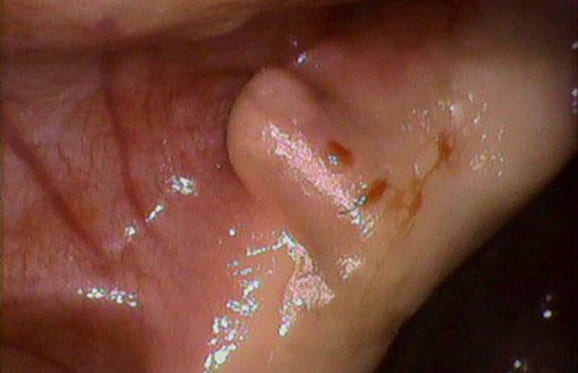 藤沢デンタルオフィスの上顎頬側の骨隆起