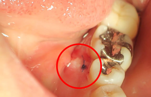 藤沢デンタルオフィスの骨隆起除去後