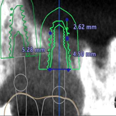 藤沢デンタルオフィスのインプラント術前
