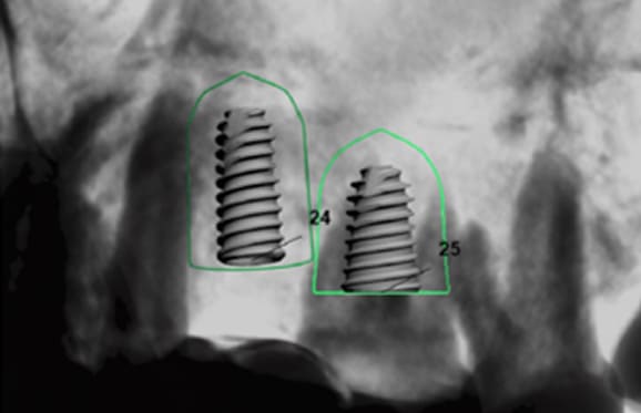 藤沢デンタルオフィスのインプラント術前