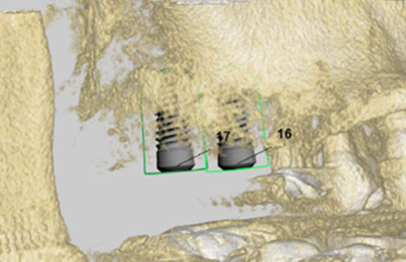 藤沢デンタルオフィスのインプラント術前