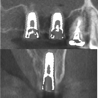 藤沢デンタルオフィスのインプラント術後