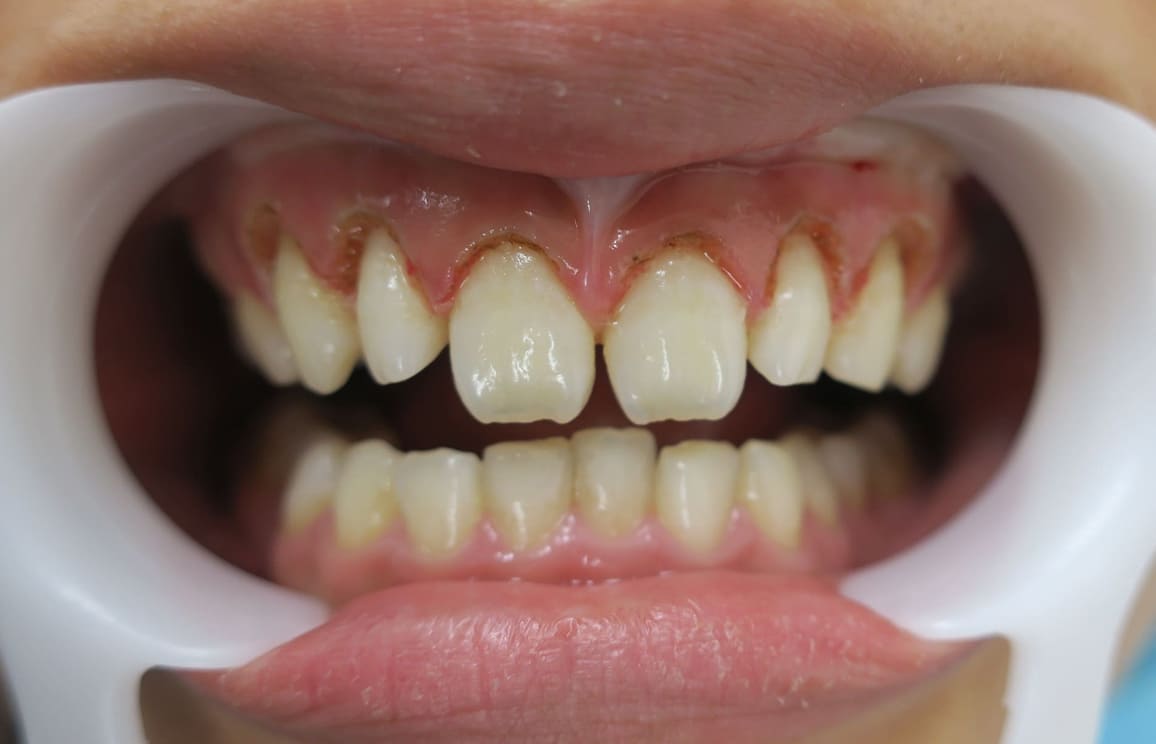 藤沢デンタルオフィスのラミネートべニア