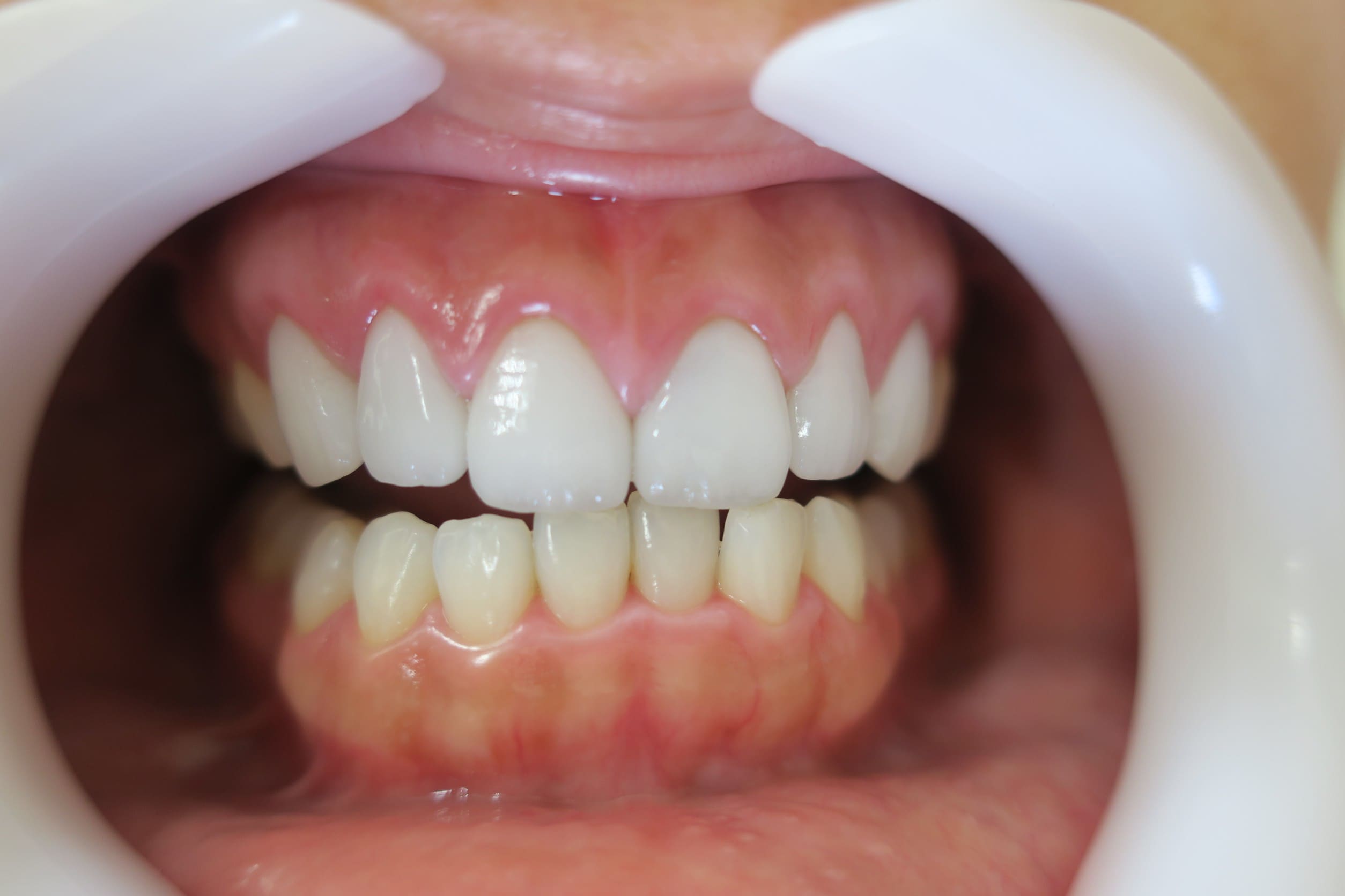 藤沢デンタルオフィスのラミネートべニア