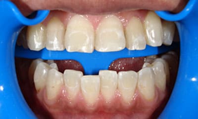 藤沢デンタルオフィスのホワイトニング術後